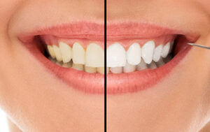 zdjęcie Metody wybielania zębów