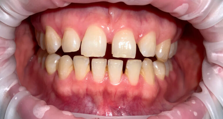 Matamorfoza 4 - przed