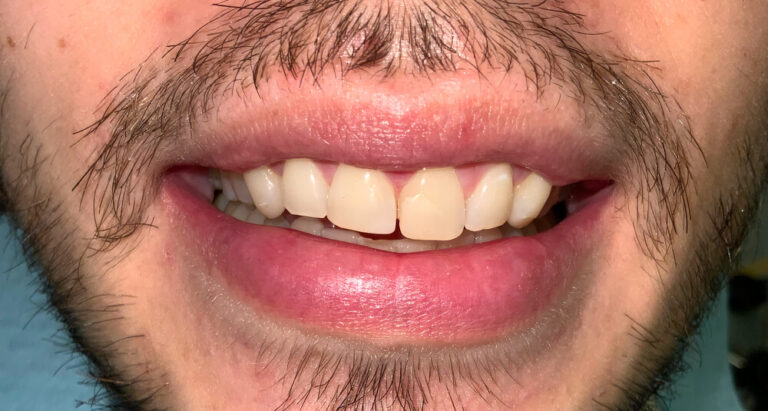 Metamorfoza 1 - przed