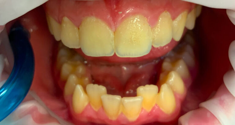 Metamorfoza 5 - przed