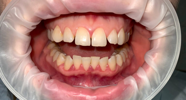 Metamorfoza 2 - przed