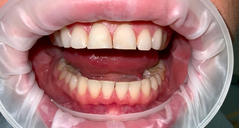 Metamorfoza 11 - przed