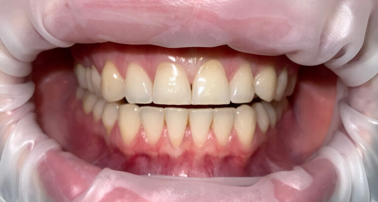 Metamorfoza 3 - przed