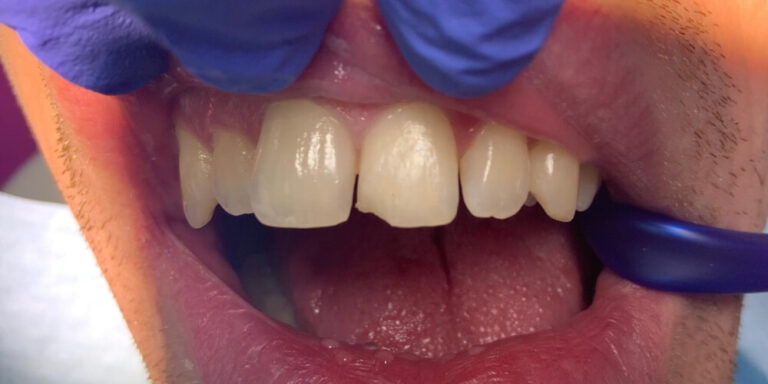 Metamorfoza 13 - przed