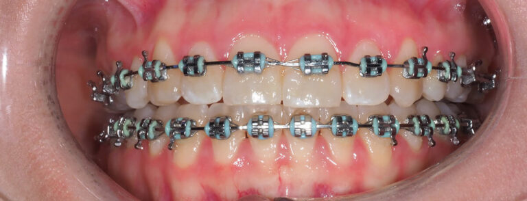 Metamorfoza 15 - przed