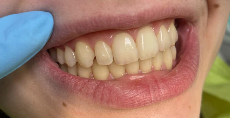 Metamorfoza 14 - przed